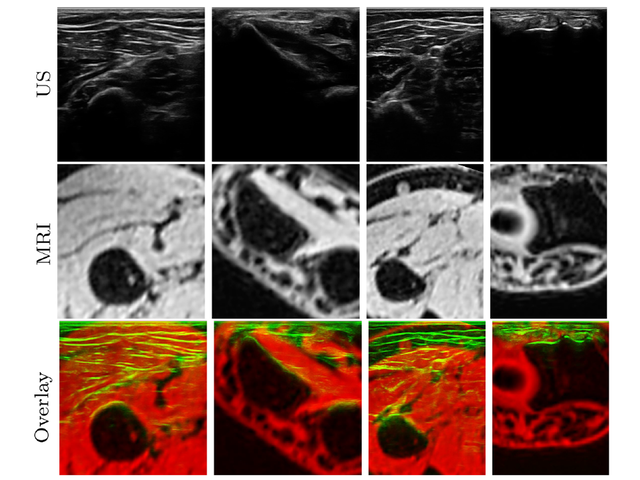 Ultrasound, MRI, and overlay views showing cross-modal forearm bone registration.