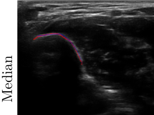 Ultrasound frame with predicted and manually annotated bone-surface contours.