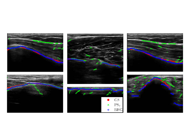 Ultrasound bone-surface examples comparing reference, phase symmetry, and factor-graph delineations.