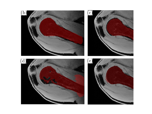 Four humerus MRI overlays comparing interactive bone-segmentation protocols.