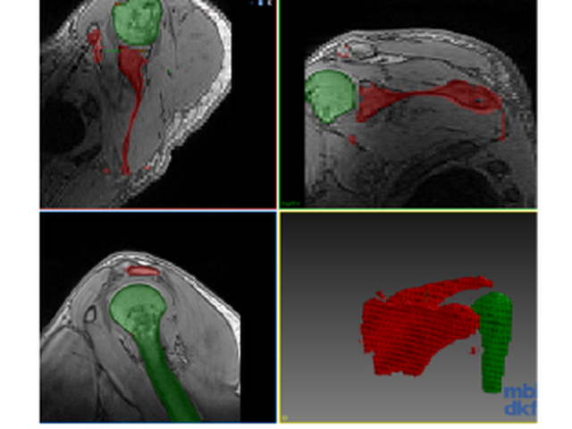 Shoulder MRI views showing retained and newly learned anatomical segmentations.