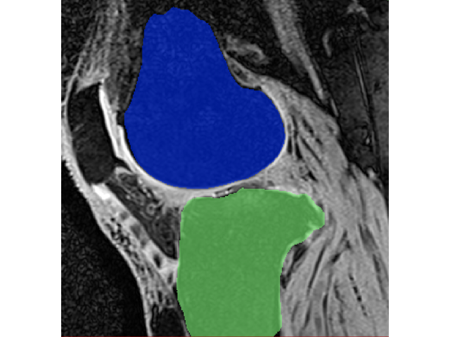 Knee MRI showing added tibia and retained femur segmentations.