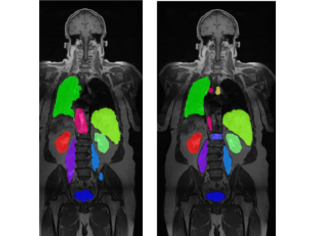 Two abdominal MRI slices comparing automatic multi-organ segmentation with ground truth.